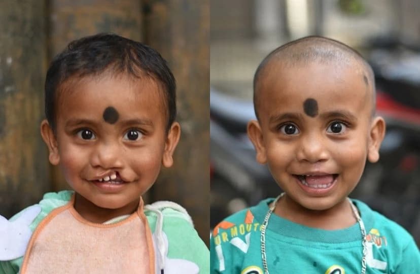 Mission Smile Program